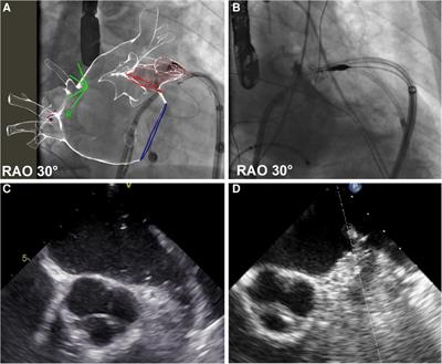 Combination of percutaneous left appendage epicardial ligation and endo-epicardial atrial fibrillation ablation